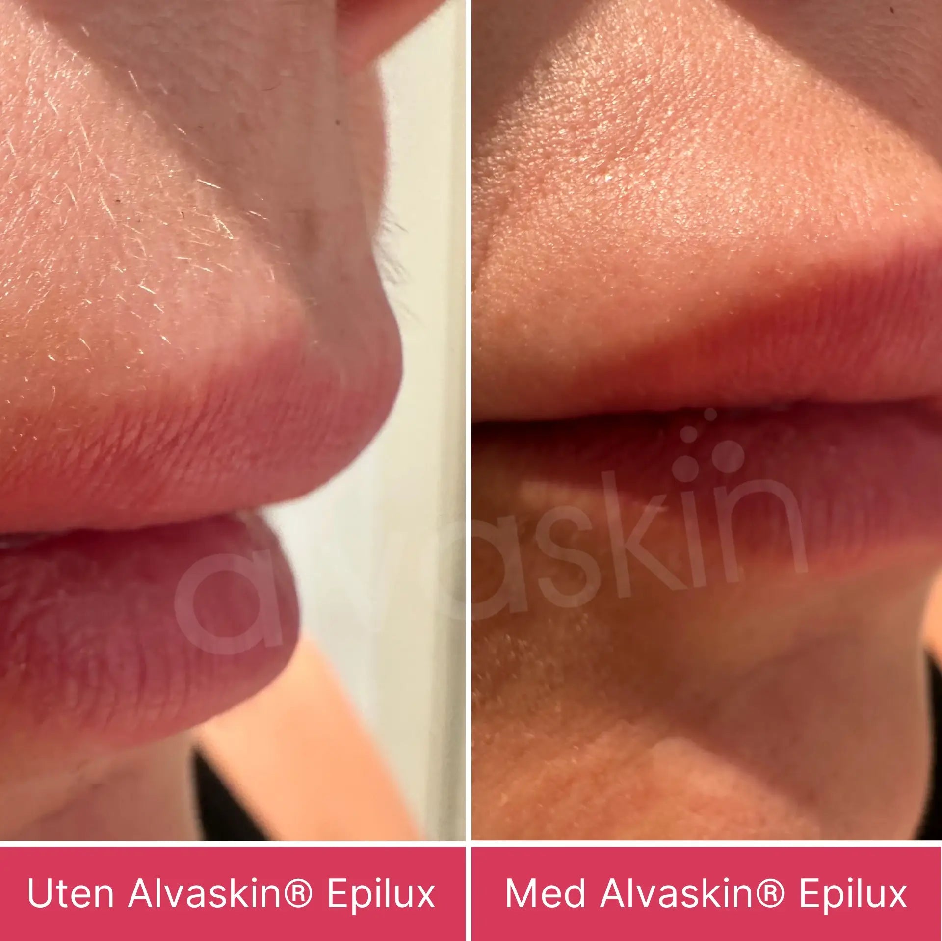 Alvaskin® Epilux