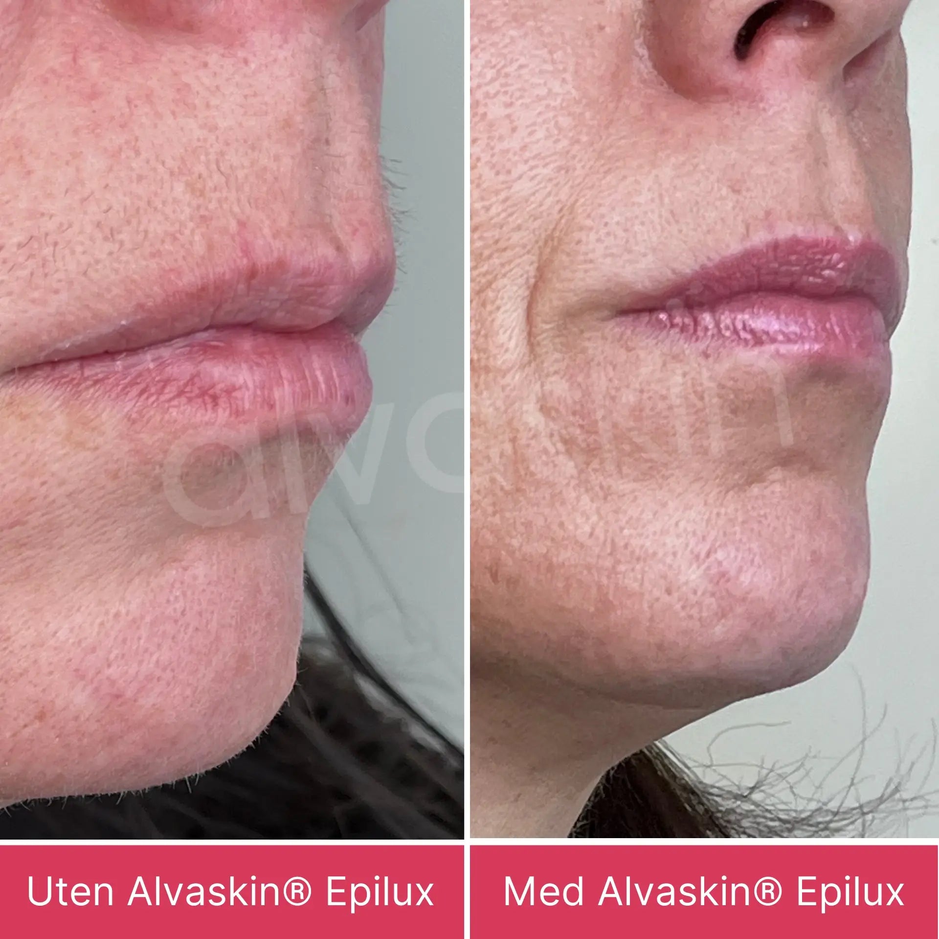 Alvaskin® Epilux