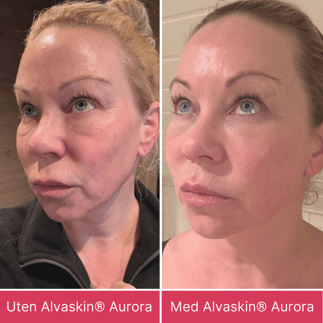 Alvaskin® Aurora